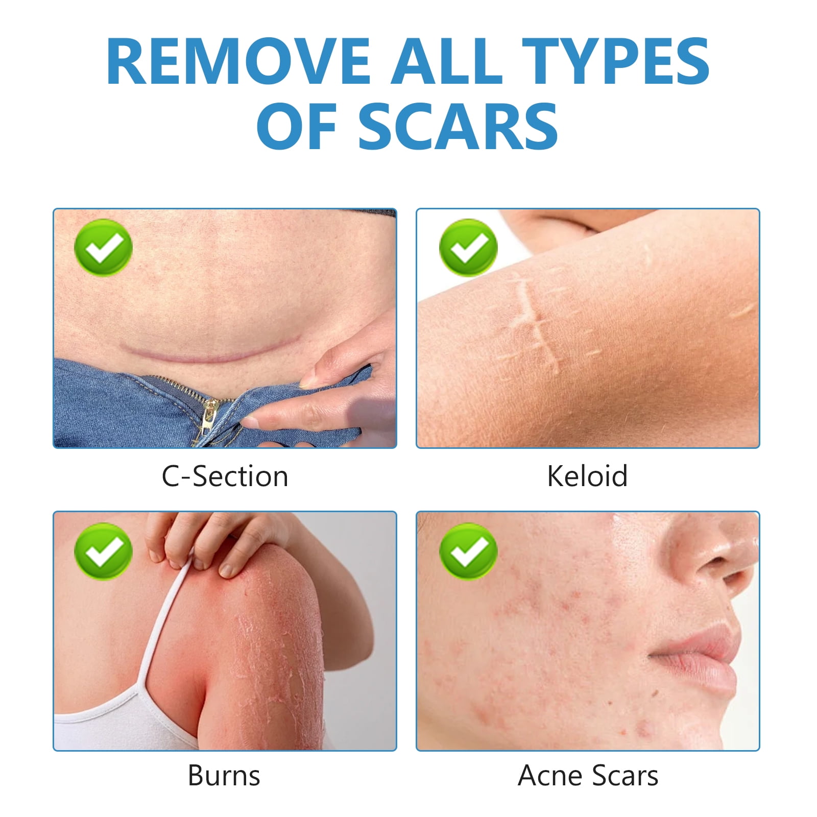 Silicone Scar Stick, Silicone Scar Sheets for Surgical Scars, Stretch Marks Removal, For Face and Body, 10g